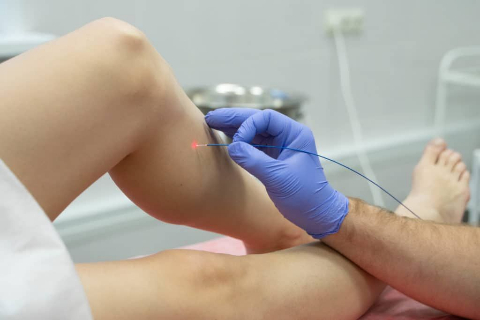 Скидка на лечение варикоза до 20%