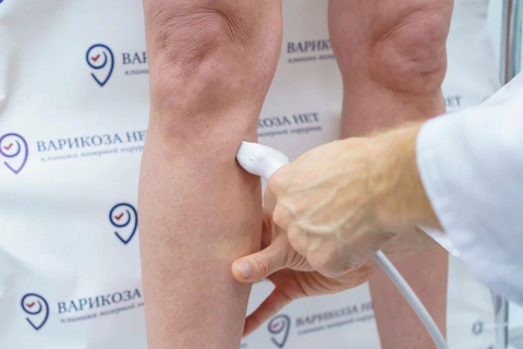 Как понять, что начинается варикоз